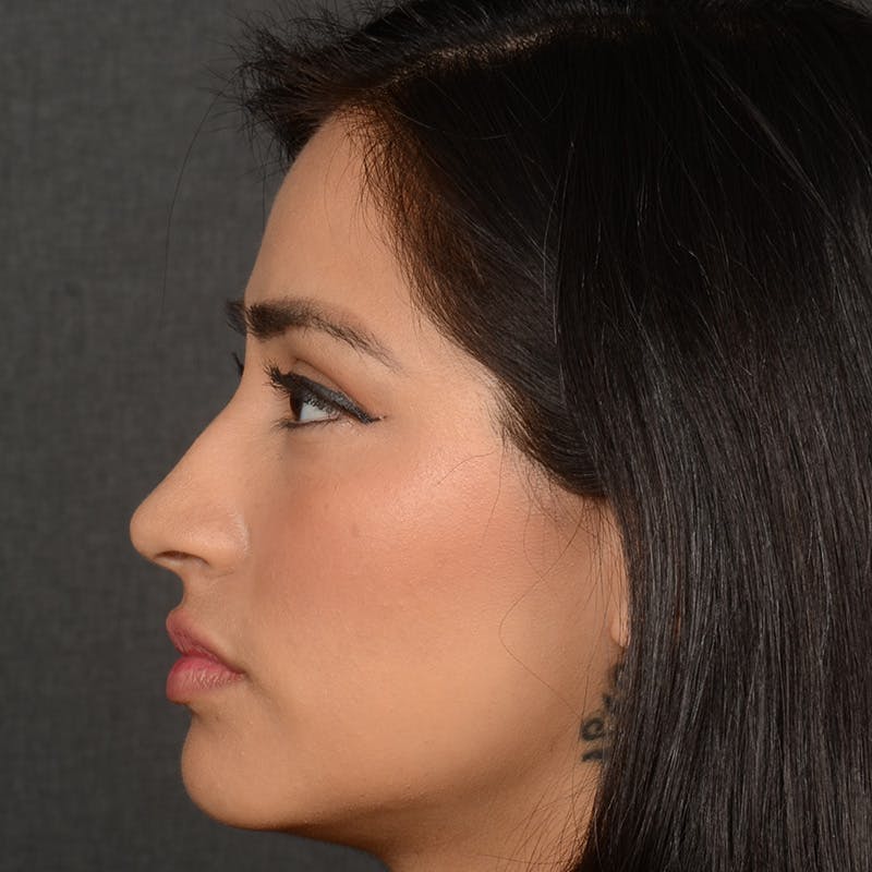 Female Rhinoplasty Before & After Gallery - Patient 303772 - Image 5