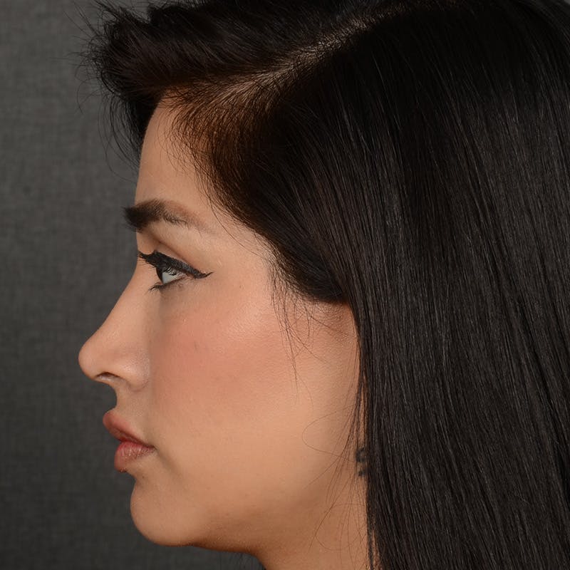 Female Rhinoplasty Before & After Gallery - Patient 303772 - Image 6