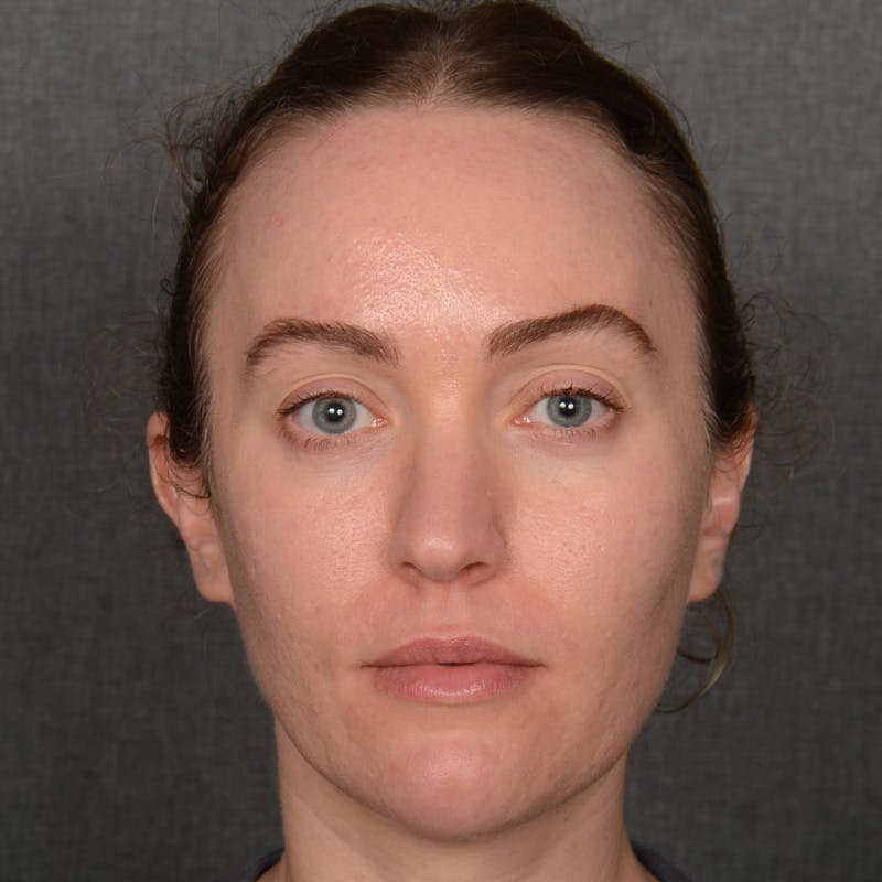 Female Rhinoplasty Before & After Gallery - Patient 181784 - Image 1