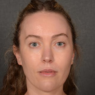 Female Rhinoplasty Before & After Gallery - Patient 181784 - Image 2