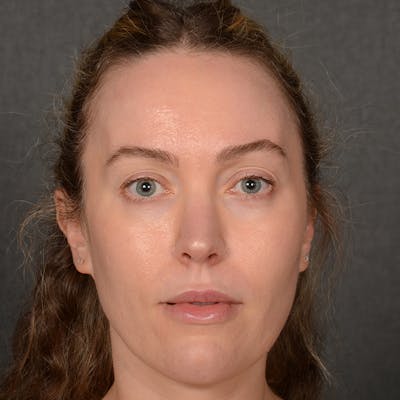 Female Rhinoplasty Before & After Gallery - Patient 181784 - Image 2