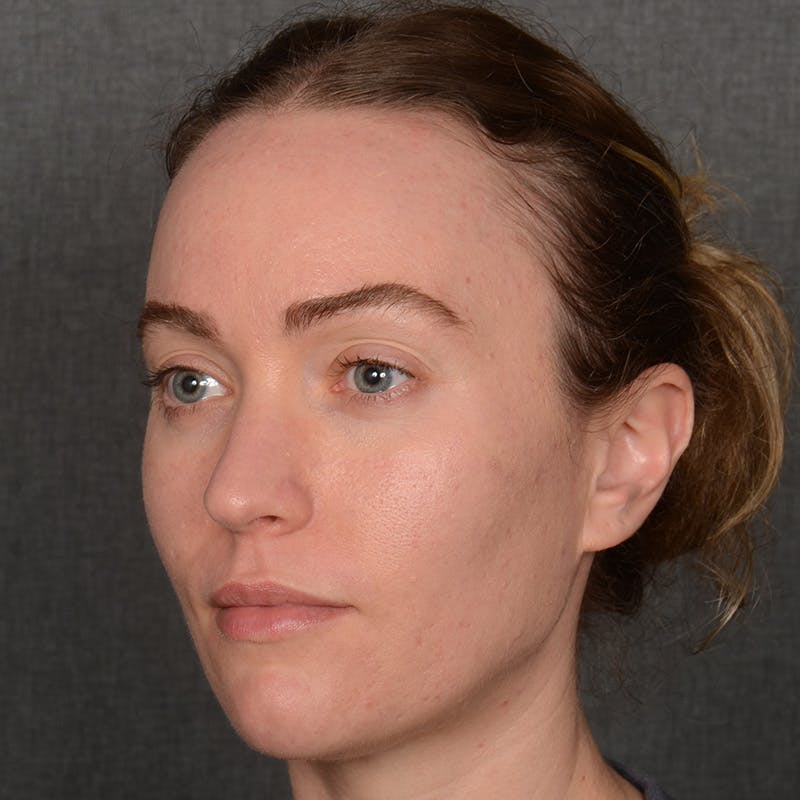 Female Rhinoplasty Before & After Gallery - Patient 181784 - Image 3
