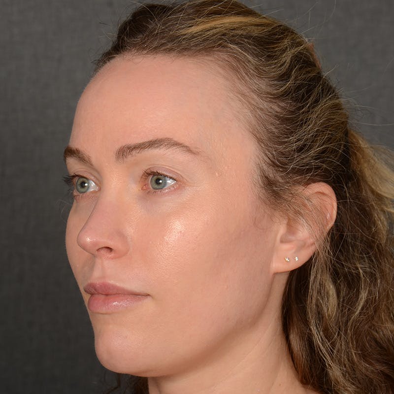 Female Rhinoplasty Before & After Gallery - Patient 181784 - Image 4