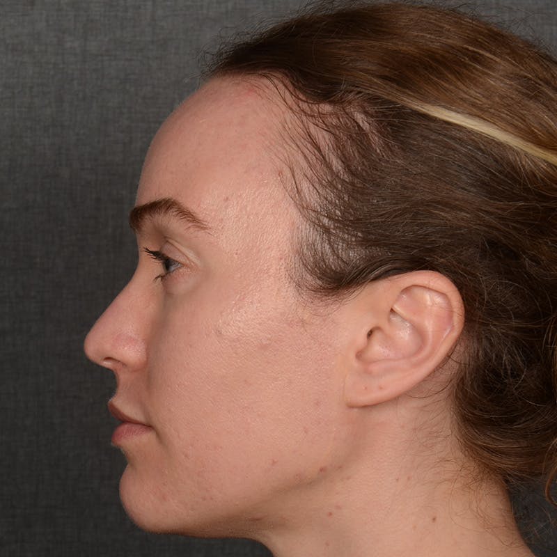 Female Rhinoplasty Before & After Gallery - Patient 181784 - Image 5