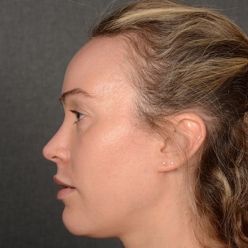 Female Rhinoplasty Before & After Gallery - Patient 181784 - Image 6