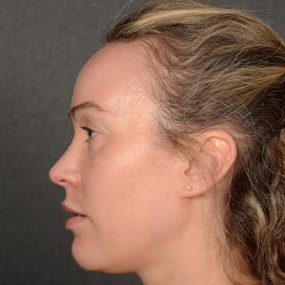 Female Rhinoplasty Before & After Gallery - Patient 181784 - Image 6