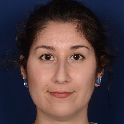 Female Rhinoplasty Before & After Gallery - Patient 340353 - Image 1