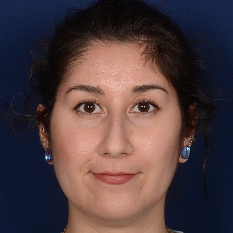 Female Rhinoplasty Before & After Gallery - Patient 340353 - Image 1