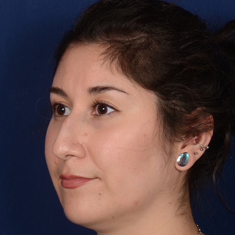Female Rhinoplasty Before & After Gallery - Patient 340353 - Image 3