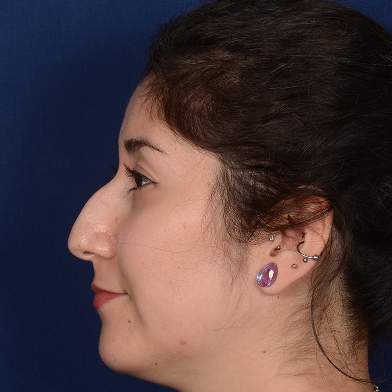Female Rhinoplasty Before & After Gallery - Patient 340353 - Image 5