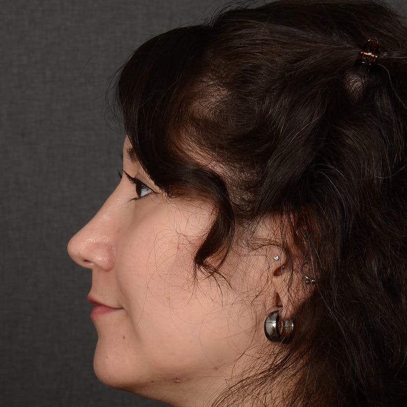 Female Rhinoplasty Before & After Gallery - Patient 340353 - Image 6