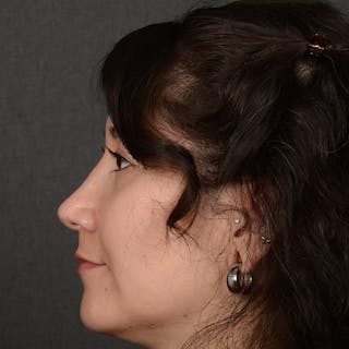 Female Rhinoplasty Before & After Gallery - Patient 340353 - Image 6