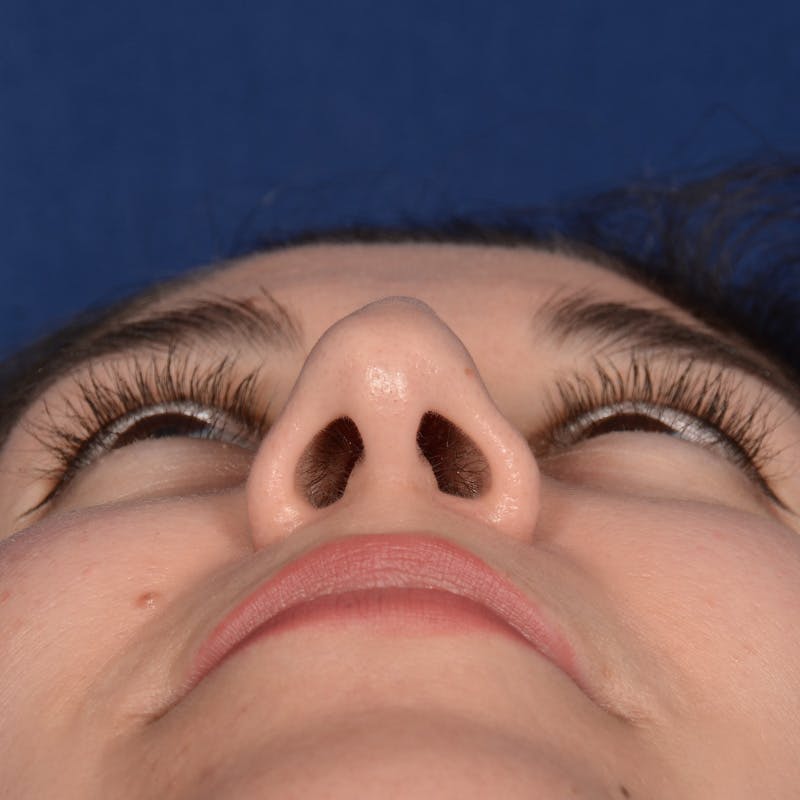 Female Rhinoplasty Before & After Gallery - Patient 340353 - Image 7