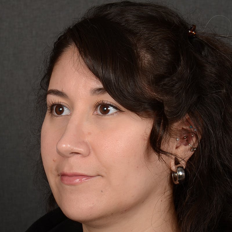 Female Rhinoplasty Before & After Gallery - Patient 340353 - Image 4
