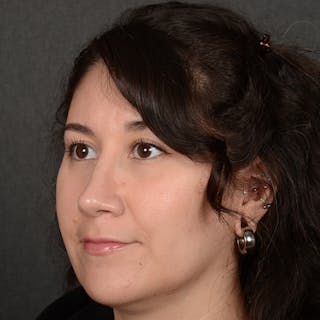 Female Rhinoplasty Before & After Gallery - Patient 340353 - Image 4