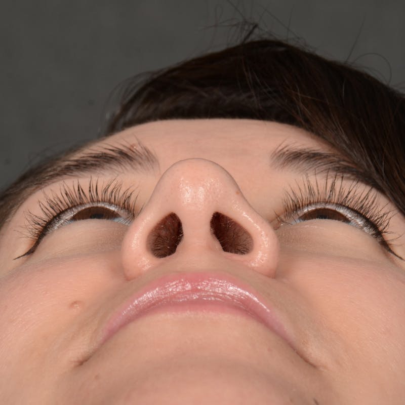 Female Rhinoplasty Before & After Gallery - Patient 340353 - Image 8