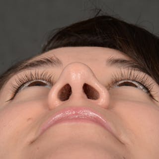 Female Rhinoplasty Before & After Gallery - Patient 340353 - Image 8