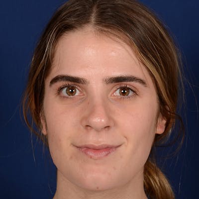 Female Rhinoplasty Before & After Gallery - Patient 303947 - Image 1