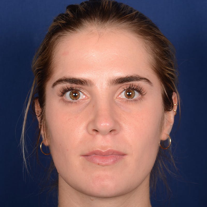 Female Rhinoplasty Before & After Gallery - Patient 303947 - Image 2