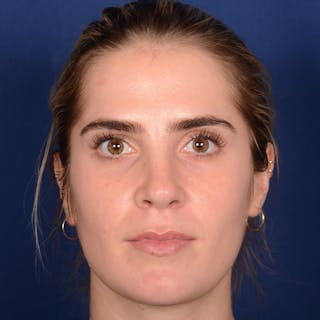 Female Rhinoplasty Before & After Gallery - Patient 303947 - Image 2