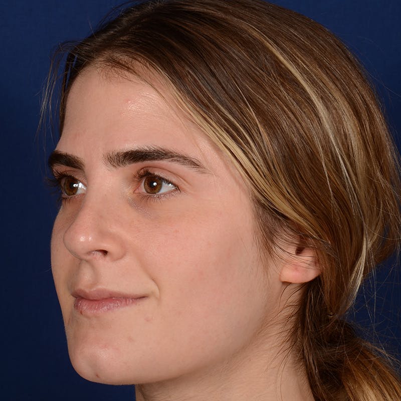 Female Rhinoplasty Before & After Gallery - Patient 303947 - Image 3