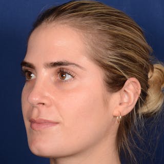 Female Rhinoplasty Before & After Gallery - Patient 303947 - Image 4