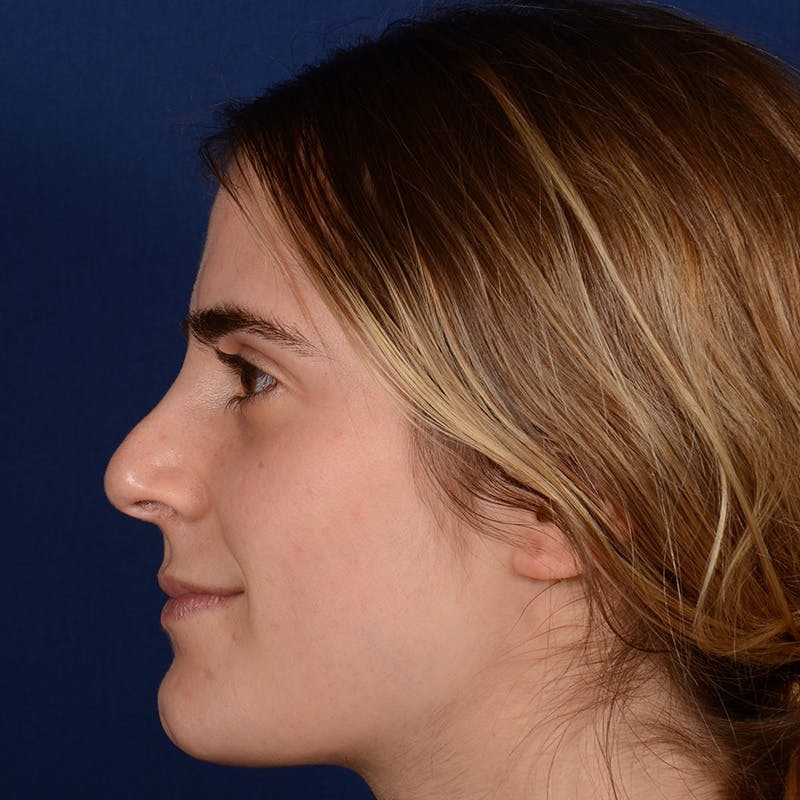 Female Rhinoplasty Before & After Gallery - Patient 303947 - Image 5