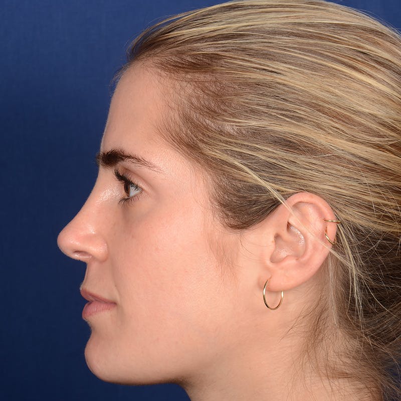 Female Rhinoplasty Before & After Gallery - Patient 303947 - Image 6