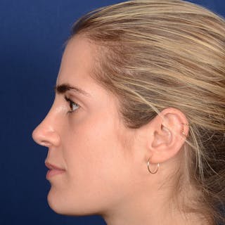 Female Rhinoplasty Before & After Gallery - Patient 303947 - Image 6