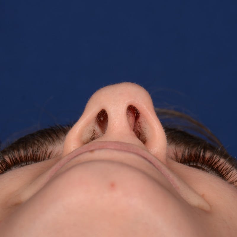 Female Rhinoplasty Before & After Gallery - Patient 303947 - Image 7