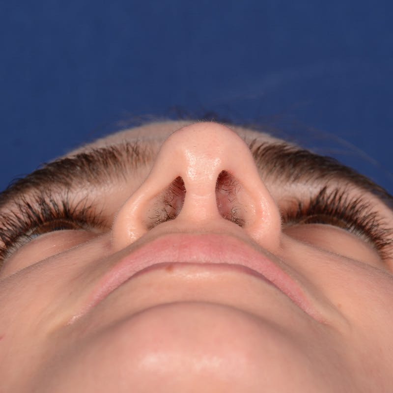 Female Rhinoplasty Before & After Gallery - Patient 303947 - Image 8