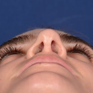 Female Rhinoplasty Before & After Gallery - Patient 303947 - Image 8