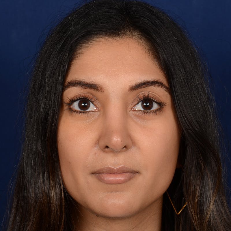 Corrective / Revision Rhinoplasty Before & After Gallery - Patient 307065 - Image 1