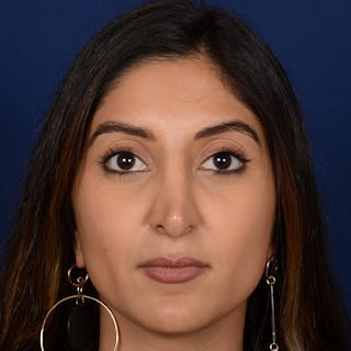 Corrective / Revision Rhinoplasty Before & After Gallery - Patient 307065 - Image 2