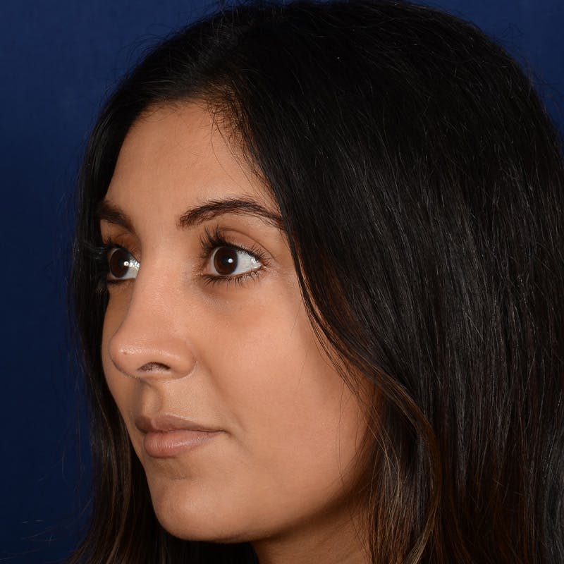 Corrective / Revision Rhinoplasty Before & After Gallery - Patient 307065 - Image 3