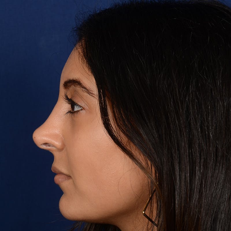 Corrective / Revision Rhinoplasty Before & After Gallery - Patient 307065 - Image 5