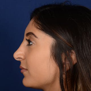 Corrective / Revision Rhinoplasty Before & After Gallery - Patient 307065 - Image 6