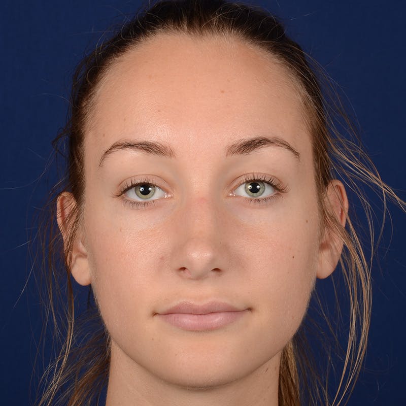 Corrective / Revision Rhinoplasty Before & After Gallery - Patient 861801 - Image 1