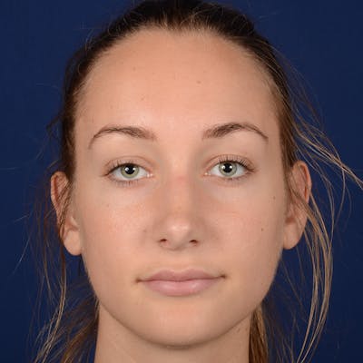 Corrective / Revision Rhinoplasty Before & After Gallery - Patient 861801 - Image 1