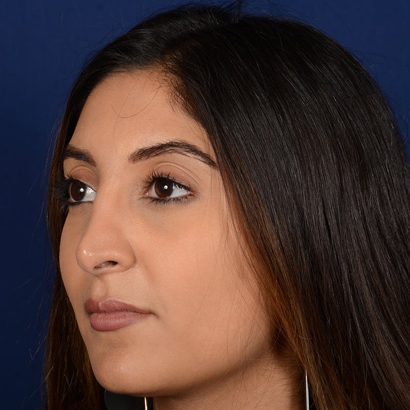 Corrective / Revision Rhinoplasty Before & After Gallery - Patient 307065 - Image 4