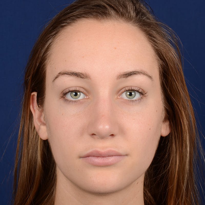 Corrective / Revision Rhinoplasty Before & After Gallery - Patient 861801 - Image 2
