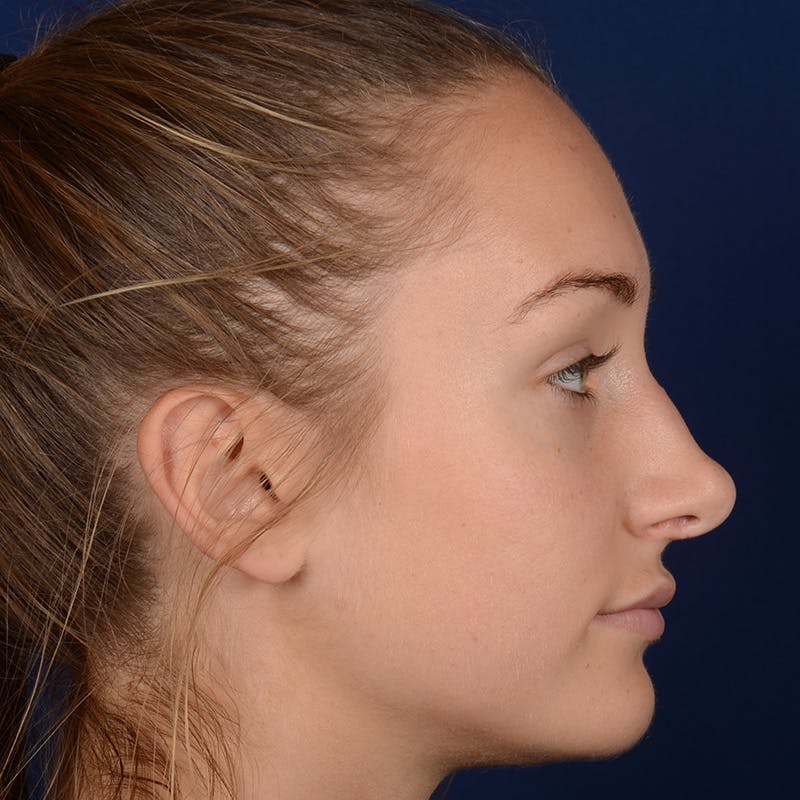 Corrective / Revision Rhinoplasty Before & After Gallery - Patient 861801 - Image 5