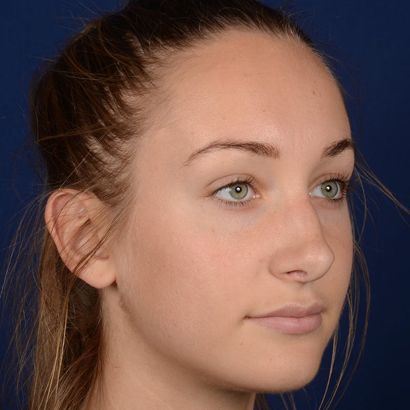 Corrective / Revision Rhinoplasty Before & After Gallery - Patient 861801 - Image 4
