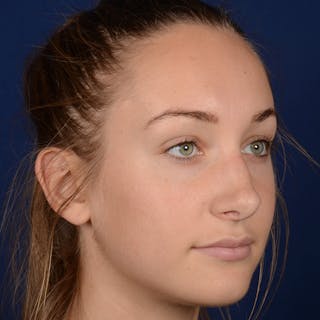 Corrective / Revision Rhinoplasty Before & After Gallery - Patient 861801 - Image 4
