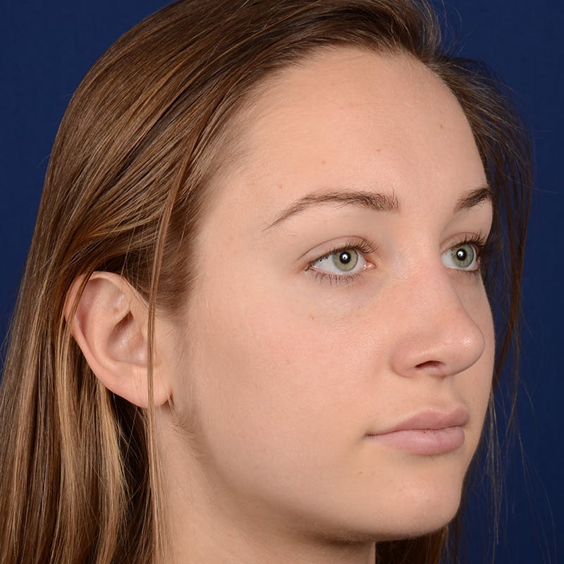 Corrective / Revision Rhinoplasty Before & After Gallery - Patient 861801 - Image 3