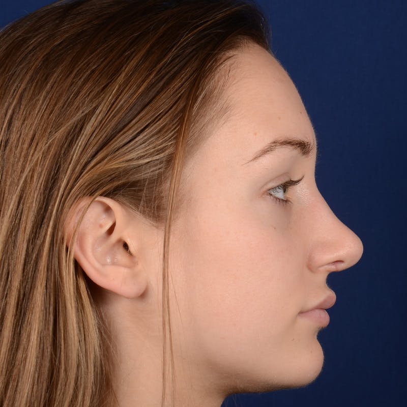 Corrective / Revision Rhinoplasty Before & After Gallery - Patient 861801 - Image 6