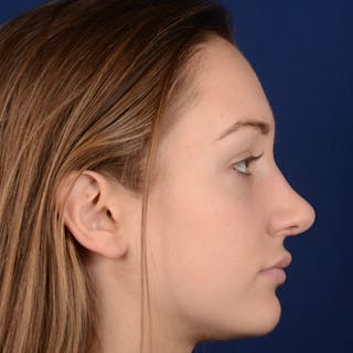 Corrective / Revision Rhinoplasty Before & After Gallery - Patient 861801 - Image 6