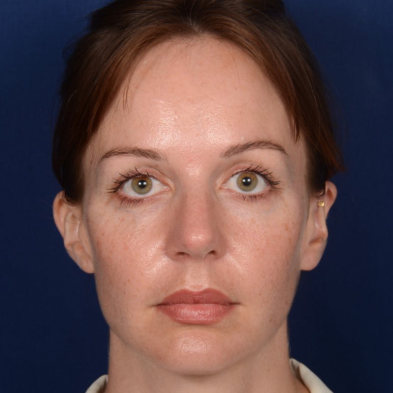 Corrective / Revision Rhinoplasty Before & After Gallery - Patient 317071 - Image 1