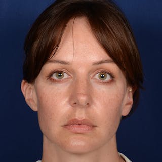 Corrective / Revision Rhinoplasty Before & After Gallery - Patient 317071 - Image 2