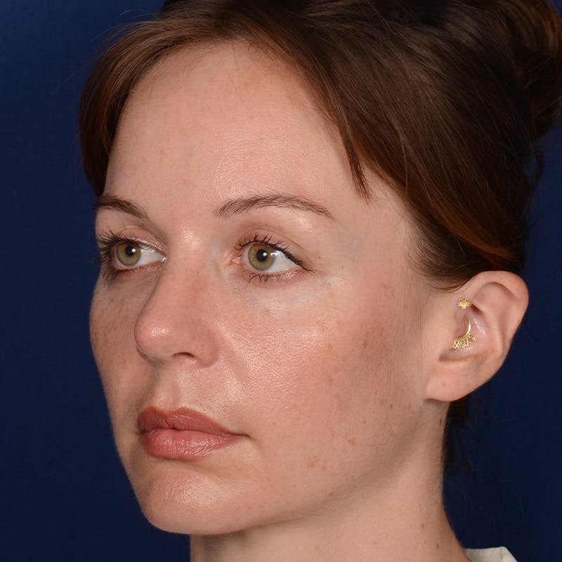 Corrective / Revision Rhinoplasty Before & After Gallery - Patient 317071 - Image 3
